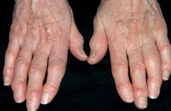 The hands are joints