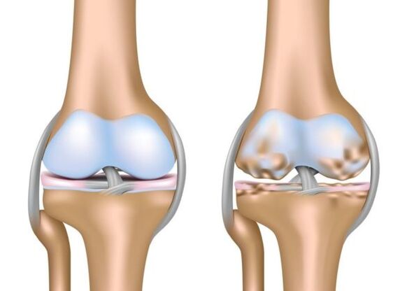 What is gonarthosis
