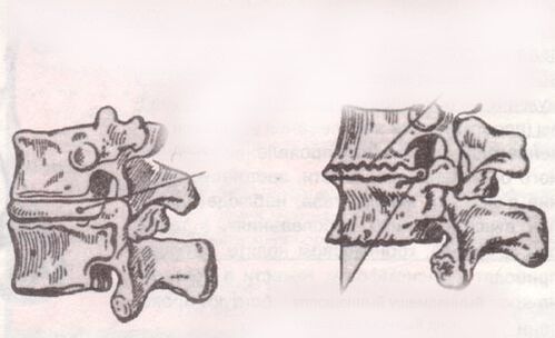The intervertebral disk with healthy and lumbar osteochondrosis