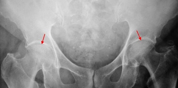 Dual-sided coksartrosis of the joint gap, the joint surfaces sclerosis