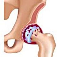 The hip joint is a joint joint