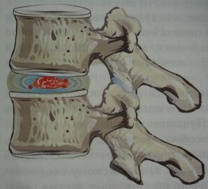 The first stage of osteochondrosis